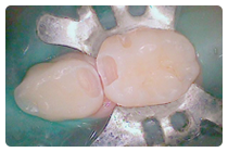 虫歯の除去後状態